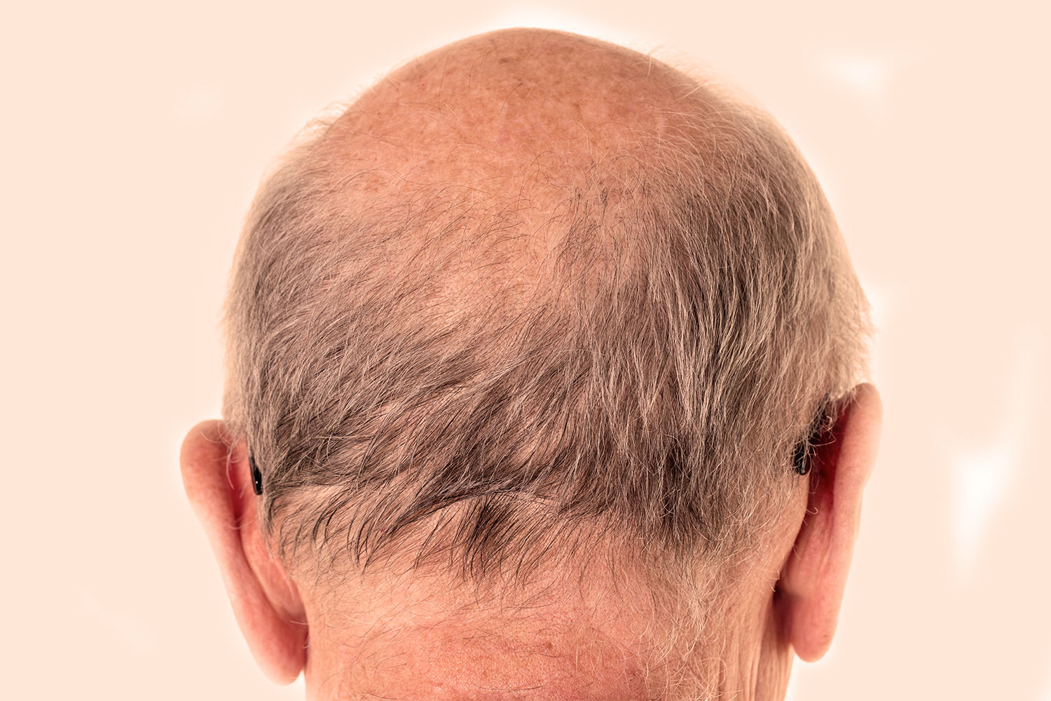 Alopecia Androgenética (Calvície) - Dra. Angélica Nóbrega