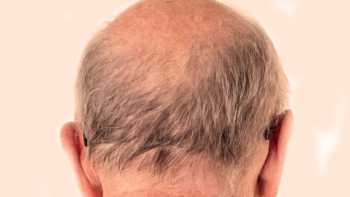 Alopecia Androgenética (Calvície)